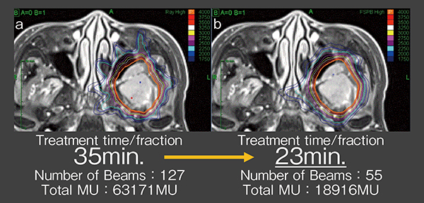 図4　コリメータの違いによる線量分布の差 a：Iris collimator, b： MLC 髄膜腫術後再発に対する治療の一例。MLC（b）は，より短時間での照射が可能。