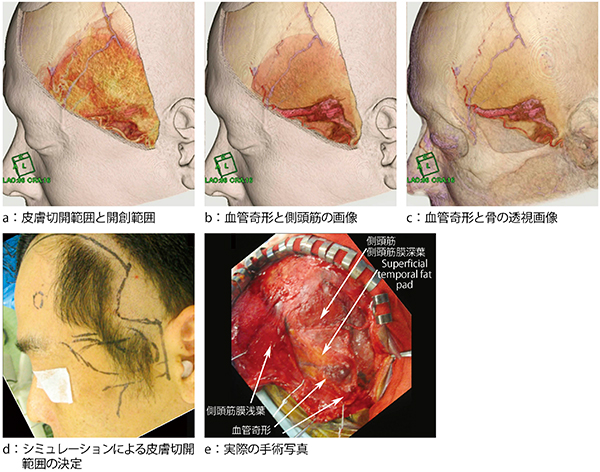 図4　レイヤーを意識したシミュレーション画像と手術写真