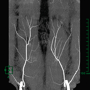 図4　両下腹壁動脈MIP画像