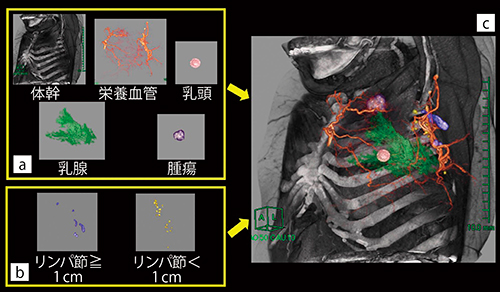 図5　乳腺腫瘍におけるマルチボリューム処理の手順