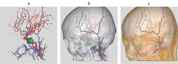 図4　症例：左中頭蓋窩髄膜腫