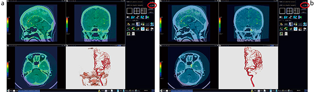 図5　CTと骨血管画像（DSA）による位置合わせ