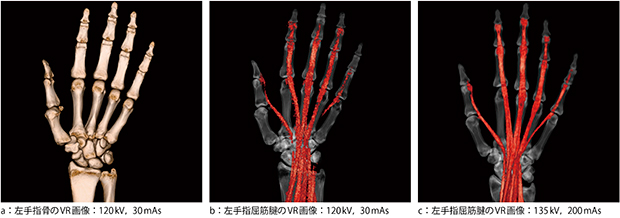 図1　撮影条件と手指屈筋腱の描出能の差異 骨のVR画像であれば30mAsで十分に作成可能であるが，腱の描出は難しいため線量を上げる必要がある。