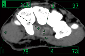 図2　120kVにおける屈筋腱と周囲組織のCT値