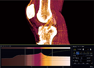 図5　左前十字靭帯再建術術後のVR画像とオパシティカーブ