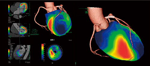 図8　心筋シンチグラフィと3D-CTのフュージョン画像