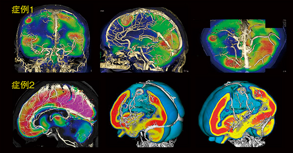 図9　転移性脳腫瘍