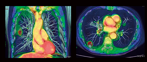 図11　肺腫瘍 PETと3D-CTAのフュージョン画像