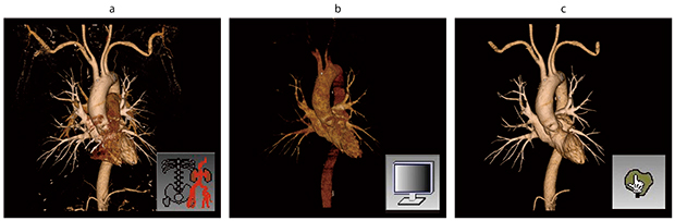 図1　肺静脈と大動脈の抽出 骨除去を行った全体像（a）を肺動脈が消えるまでウィンドウ調節し（b），肺静脈を選択抽出（c）して肺動脈を消去する。