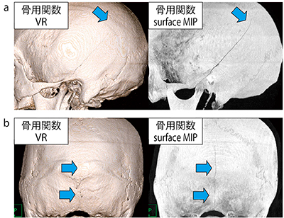 図5　VR画像とsurface MIP画像の骨折線の描出能の違い a：側頭骨骨折症例　b：後頭骨骨折症例