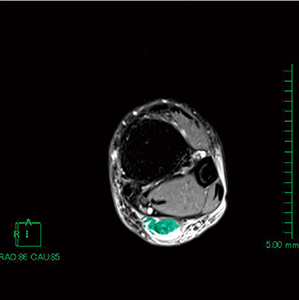 図3　アキレス腱部選択画像 計測するスライスを決め，アキレス腱部（緑色）を目視にて選択していく。