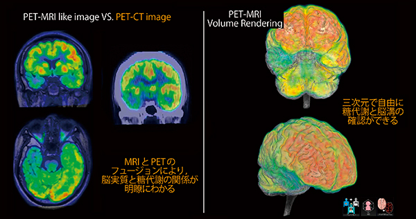図2　PETとMRIのフュージョン画像