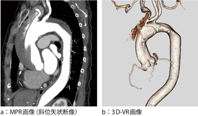 図1　大動脈解離症例でのMPR画像と3D-VR画像