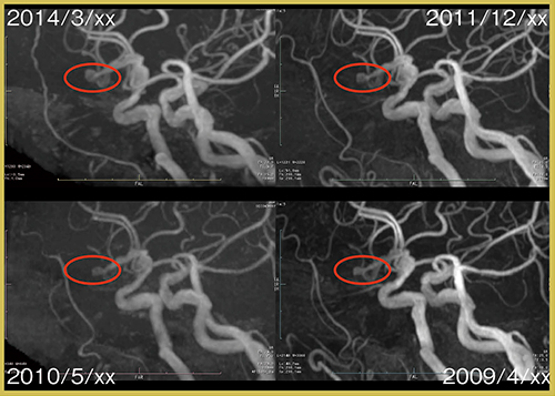 図5　MRA画像のレジストレーション（脳動脈瘤）