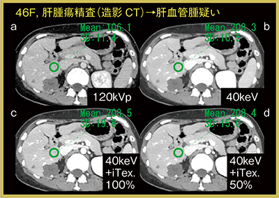 図3　造影CTによる肝腫瘍精査