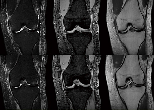 図1　膝の拡大画像 16chフレキシブルSPEEDERは、患部に密着させることができるため、高いSNRを得ることが可能。高SNRを生かした高分解能撮像になり、軟骨構造が明瞭に描出されている。