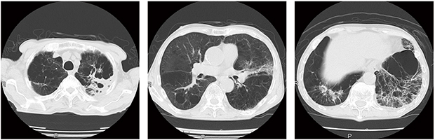 図1　気腫合併肺線維症（CPFE）フォロー