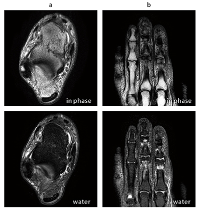 図1　WFS　T2強調画像 指や足先の磁場均一性が劣化する領域においても、WFSでは安定した脂肪抑制画像が得られる。 a：前距腓靭帯（ATFL）軽度損傷　b：中指中節骨骨腫瘍