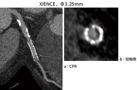 症例2　#6にステント留置（XIENCE、Φ3.25mm） ステント遠位に軽度内膜肥厚を認める。