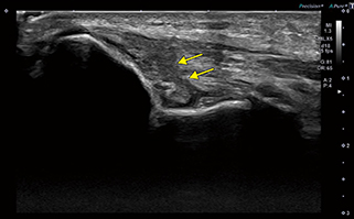 図2　肘内側側副靭帯（UCL）損傷 UCLに低輝度の部分（←）が認められ断裂していることがわかる。