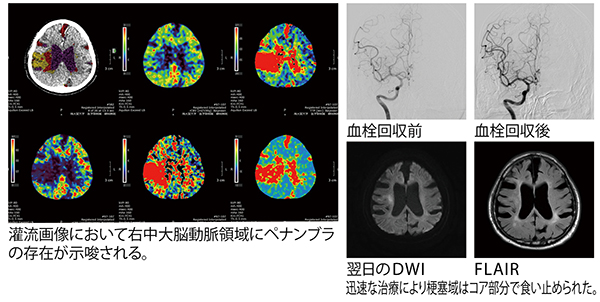 図2　急性期脳梗塞症例 通常血栓回収療法はM1のような太い血管に対して実施される。本症例はM3の塞栓だが、ペナンブラが広範であったため血栓回収に踏み切った。 左　：Vitrea  CT 4D Brain Perfusion解析画面 右上：DSA画像 右下：MR画像