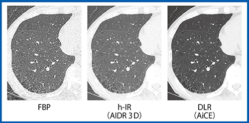 図3　低線量CT検診における肺野の画質比較