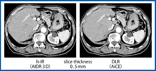 図7　超高精細CT（Aquilion Precision）における腹部画像の比較