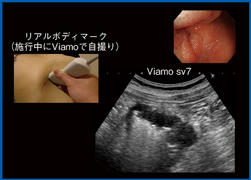 図1　Viamo sv7による横行結腸がんのスクリーニング