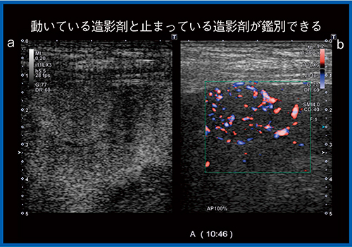 図4　新・カラードプラによる肝腺腫のDual Image表示 a：CHI＋Fundamental　b：SMI