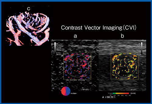 図6　肝細胞がんのCVI a：in-out imaging　b：velocity imaging　c：3D SMI