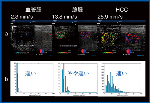 図7　CVIによる腫瘍内血管の速度分布 a：velocity imaging　b：ヒストグラム