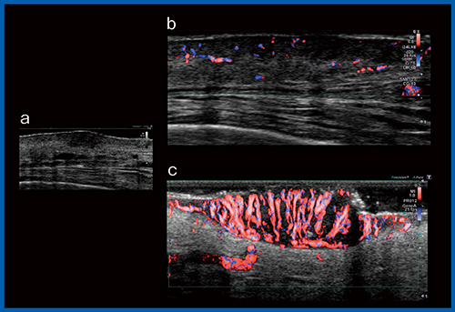 図11　頬の血管肉腫，放射線治療後 a：Bモード画像 b：Ultra HFP（24MHz） c：Super HFP（33MHz）（W.I.P.）