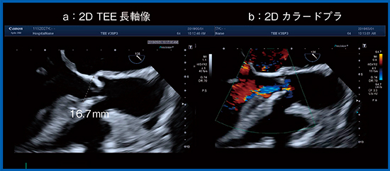 図1　症例1：大動脈弁狭窄症の2D TEEによるTAVI術前評価