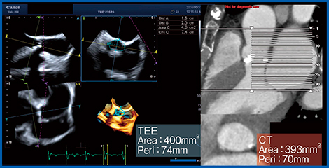 図2　症例1：3D TEEとCTによる大動脈弁輪面積の計測