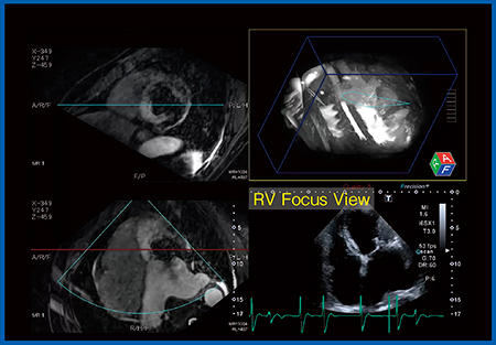 図8　MitralClip治療後の症例のRV Focus View