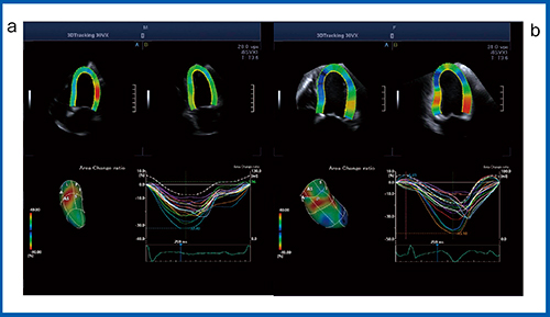 図9　3D-WMTによるストレイン解析 a：急性心筋梗塞　b：たこつぼ型心筋症