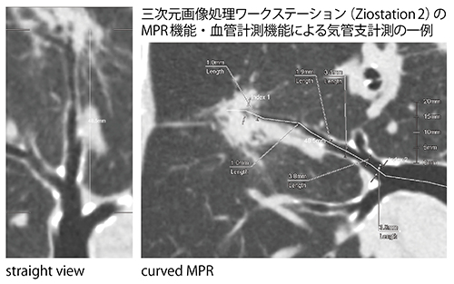 図6　三次元画像処理ワークステーションのMPR機能・血管計測機能による気管支計測の一例