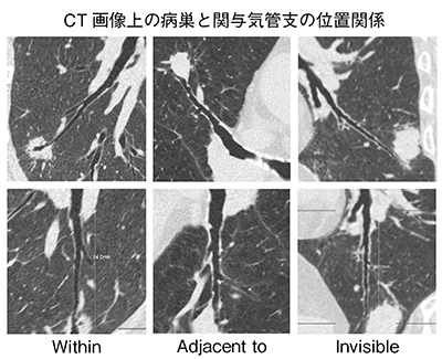 図7　CT画像上の病巣と関与気管支の位置関係