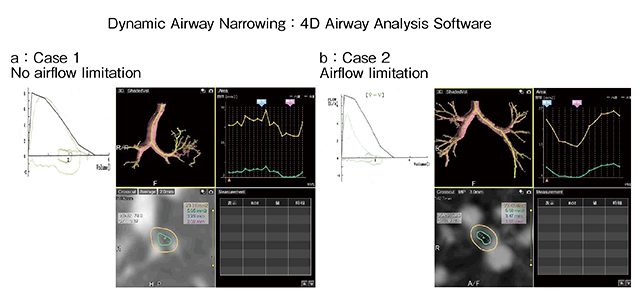 図8　4D Airway Analysisを用いた解析 case1（a）では呼吸による気管支形状の変化はほぼ見られないが、case2（b）では呼吸に伴い気管支形状が明らかに狭小化している。