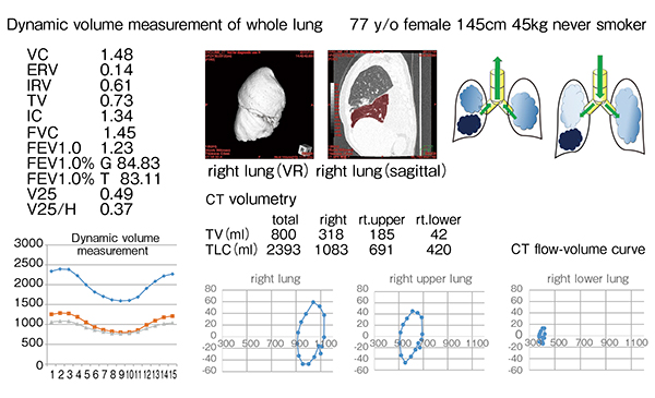 図10　右下葉の入口部に閉塞がある症例の全肺のダイナミックボリューム測定（77歳、女性）