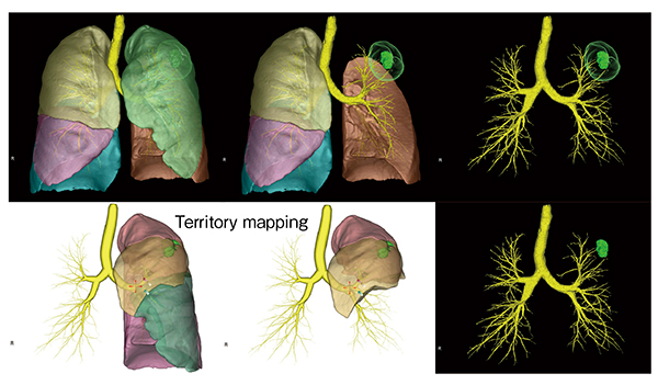 図11　テリトリーマッピング法を用いた肺の領域分割