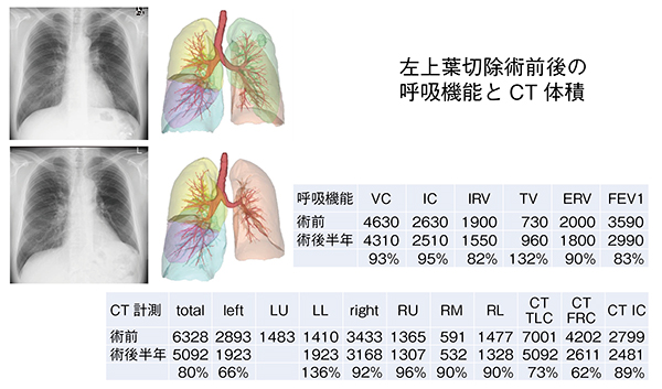 図12　左上葉切除前後の呼吸機能とCT体積