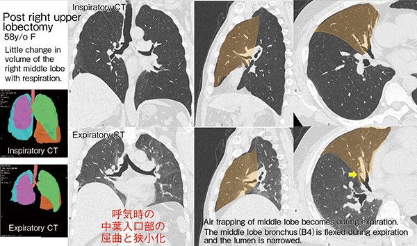 図13　症例1：右肺上葉切除後（58歳、女性）