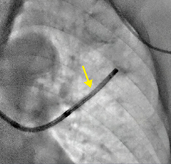 症例2　新画像処理条件の透視像。気管支鏡内のEBUSの先端の位置も明瞭に見える（↓）。