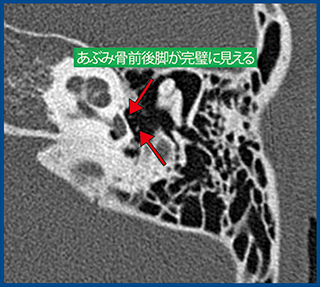 図1　Aquilion Precisionで撮影した中内耳CT（0.25mm厚）