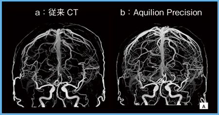 図1　前交通動脈瘤症例の描出能の比較
