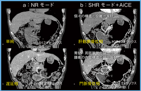 図3　症例3：胃粘膜下腫瘍