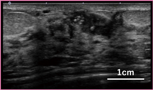 図1　超高周波プローブ｢PLI-2004BX｣による乳腺のBモード画像（画像提供：名古屋医療センター・森田孝子先生）