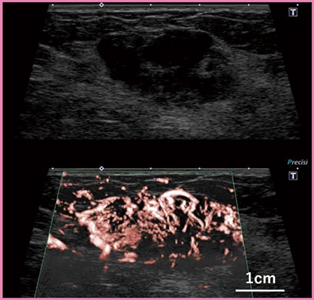 図2　高周波プローブ｢PLI-1205BX｣の乳腺造影SMI画像（画像提供：高松平和病院・何森亜由美先生）