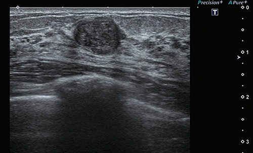 図1　PLI-2004BXの乳腺画像 （画像ご提供：名古屋医療センター・森田孝子先生）